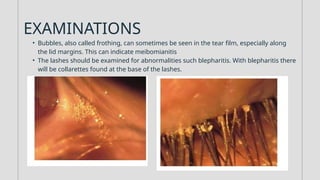 Blepharitis_vidalaka_110639_0000000.pptx