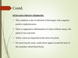Contd.
b)Ulcerative/Infective blepharitis:
 This condition is due to infection of lid margin with coagulase
positive staphylococcus.
 There is suppurative inflammation of ciliary follicles along with
gland of zeis and moll.
 Yellow crusts are deposited at the roots of eyelash.
 On removing the crusts, small ulcers appear around the base of
the eyelashes which bleed freely.
 