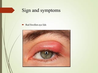 Sign and symptoms
 Red Swollen eye lids
 