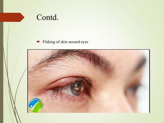 Contd.
 Flaking of skin around eyes
 