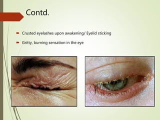 Contd.
 Crusted eyelashes upon awakening/ Eyelid sticking
 Gritty, burning sensation in the eye
 
