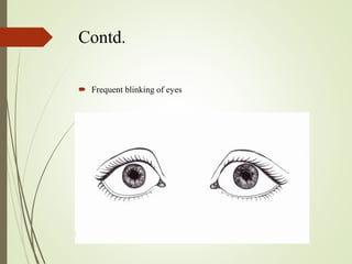 Contd.
 Frequent blinking of eyes
 