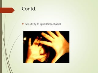 Contd.
 Sensitivity to light (Photophobia)
 