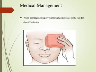 Medical Management
 Warm compression: apply warm wet compresses to the lids for
about 2 minutes.
 