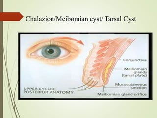 Chalazion/Meibomian cyst/ Tarsal Cyst
 
