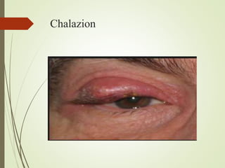 Chalazion
 