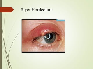 Stye/ Hordeolum
 