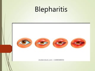 Blepharitis
 