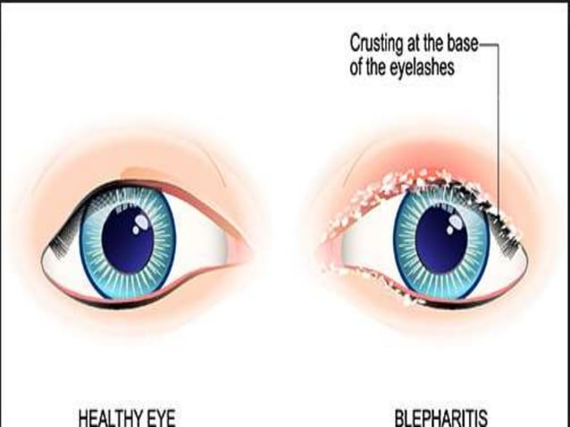 Blepharitis, chalazion, stye | PPTX