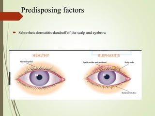 Predisposing factors
 Seborrheic dermatitis-dandruff of the scalp and eyebrow
 