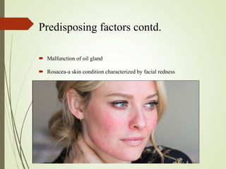 Predisposing factors contd.
 Malfunction of oil gland
 Rosacea-a skin condition characterized by facial redness
 