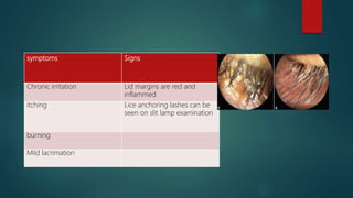 symptoms Signs
Chronic irritation Lid margins are red and
inflammed
itching Lice anchoring lashes can be
seen on slit lamp examination
burning
Mild lacrimation
 