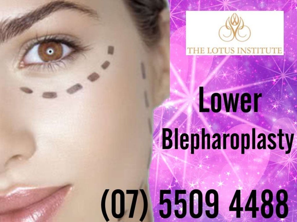 Lower Blepharoplasty (Eyelid Surgery) Gold Coast Southport Clinic