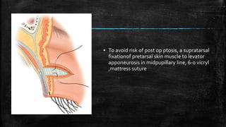 ▪ To avoid risk of post op ptosis, a supratarsal
fixationof pretarsal skin muscle to levator
apponeurosis in midpupillary line, 6-0 vicryl
,mattress suture
 