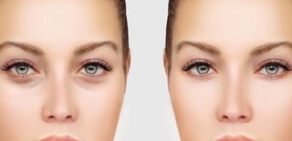 Blepharoplasty