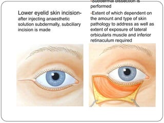 Subciliary Approach Incision Blepharoplasty kgmc | PPTX
