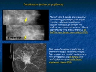 Αδενική εστία & ομάδα αποτιτανώσεων
με ύποπτους χαρακτήρες στον ετήσιο
επανέλεγχο διαφοροποιήθηκε σε
μέγεθος και σχήμα, με αύξηση του
αριθμού των αποτιτανώσεων και αλλαγή
μορφολογίας τους, διαγνώστηκε ως BI-
RADS 4 έγινε βιοψία που ανέδειξε DCIS.
Εδώ μια μάζα υψηλής πυκνότητας με
ακανόνιστο σχήμα και ακανθωτά όρια. 
Παρατηρήστε την εισολκή του δέρματος.
Αυτό αναφέρθηκε ως BI-RADS 5 και
αποδείχθηκε ότι ήταν ένα διηθητικό
καρκίνωμα πόρου (IDC).
Παραδείγματα (εικόνες σε μεγέθυνση)Παραδείγματα (εικόνες σε μεγέθυνση)
 