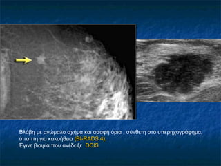 Βλάβη με ανώμαλο σχήμα και ασαφή όρια , σύνθετη στο υπερηχογράφημα,
ύποπτη για κακοήθεια ((BI-RADS 4).BI-RADS 4).
Έγινε βιοψία που ανέδειξε DCISDCIS
 