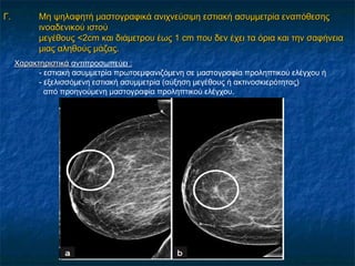 Γ.Γ. MMη ψηλαφητή μαστογραφικά ανιχνεύσιμηη ψηλαφητή μαστογραφικά ανιχνεύσιμη εστιακήεστιακή ασυμμετρία εναπόθεσηςσυμμετρία εναπόθεσης
ινοαδενικού ιστούινοαδενικού ιστού
μεγέθους <2μεγέθους <2cmcm και διάμετρου έως 1και διάμετρου έως 1 cmcm που δεν έχει τα όρια και την σαφήνειαπου δεν έχει τα όρια και την σαφήνεια
μιας αληθούς μάζας.μιας αληθούς μάζας.
ΧαρακτηριστικάΧαρακτηριστικά αντιπροσωπεύει ::
- εστιακή ασυμμετρία πρωτοεμφανιζόμενη σε μαστογραφία προληπτικού ελέγχου ή
- εξελισσόμενη εστιακή ασυμμετρία (αύξηση μεγέθους ή ακτινοσκιερότητας)
από προηγούμενη μαστογραφία προληπτικού ελέγχου.
 