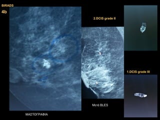 4b4b
2.DCIS grade II2.DCIS grade II
1.DCIS grade III1.DCIS grade III
Μετά BLES
ΜΑΣΤΟΓΡΑΦΙΑ
BIRADSBIRADS
 
