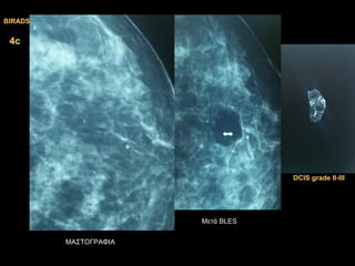 4c4c
ΜΑΣΤΟΓΡΑΦΙΑ
Μετά BLES
DCIS gradeDCIS grade ΙΙ-ΙΙ-IIIIII
BIRADSBIRADS
 