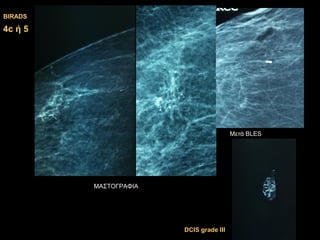 ΜΑΣΤΟΓΡΑΦΙΑ
44cc ή 5ή 5
BIRADSBIRADS
Μετά BLES
DCIS grade IIIDCIS grade III
 
