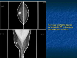 Αδυναμία εκτέλεσης βιοψίας
με μέθοδο BLES σε βλάβη με
οπισθοθηλαία εντόπιση
 