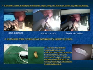 2.2. Ακολουθεί τοπική αναισθησία και διάνοιξη μικρής τομής στο δέρμα για είσοδο της βελόνας βιοψίας.Ακολουθεί τοπική αναισθησία και διάνοιξη μικρής τομής στο δέρμα για είσοδο της βελόνας βιοψίας.
Τοπική αναισθησία Διάνοιξη με νυστέρι Είσοδος ηλεκτροδίου
3.3. Στο τελευταίο στάδιο η συσκευήΣτο τελευταίο στάδιο η συσκευή BLESBLES αναλαμβάνει την εξαίρεση της βλάβης.αναλαμβάνει την εξαίρεση της βλάβης.
4.4. Το υλικό στη συνεχείαΤο υλικό στη συνεχεία
παραλαμβάνεται από τοπαραλαμβάνεται από το
παθολογοανατομικό εργαστήριοπαθολογοανατομικό εργαστήριο
το οποίο φροντίζει να γίνειτο οποίο φροντίζει να γίνει
ακτινολογική λήψη του ιστικούακτινολογική λήψη του ιστικού
τεμαχίου για επιβεβαίωση τηςτεμαχίου για επιβεβαίωση της
σωστής εξαίρεσης (μαστογραφίασωστής εξαίρεσης (μαστογραφία
παρασκευάσματος).παρασκευάσματος).
 