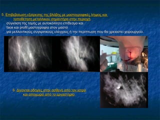 5.5. Επιβεβαίωση εξαίρεσης της βλάβης με μαστογραφικές λήψεις καιΕπιβεβαίωση εξαίρεσης της βλάβης με μαστογραφικές λήψεις και
τοποθέτηση μεταλλικού σημαντήρα στην περιοχήτοποθέτηση μεταλλικού σημαντήρα στην περιοχή..
σύγκλιση της τομής με αυτοκόλλητο επίδεσμο καισύγκλιση της τομής με αυτοκόλλητο επίδεσμο και
faceface και profil μαστογραφία στον μαστόκαι profil μαστογραφία στον μαστό
για μελλοντικούς συγκριτικούς ελέγχους ή την περίπτωση που θα χρειαστεί χειρουργείο.για μελλοντικούς συγκριτικούς ελέγχους ή την περίπτωση που θα χρειαστεί χειρουργείο.
6.6. Δίνονται οδηγίες στην ασθενή από τον ιατρόΔίνονται οδηγίες στην ασθενή από τον ιατρό
και αποχωρεί από το εργαστήριοκαι αποχωρεί από το εργαστήριο..
 