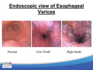 Endoscopic view of Esophageal
Varices
Normal Low Grade High Grade
 