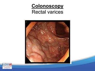 Colonoscopy
Rectal varices
 