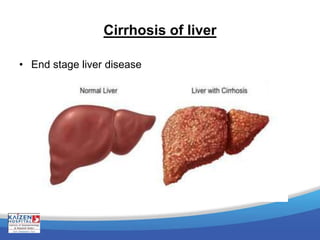 Cirrhosis of liver
• End stage liver disease
 