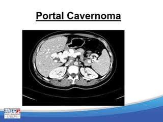 Portal Cavernoma
 