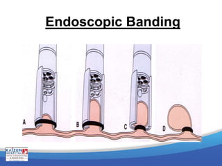 Endoscopic Banding
 