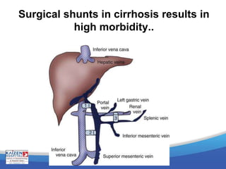 Surgical shunts in cirrhosis results in
high morbidity..
 