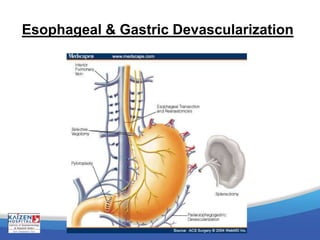 Esophageal & Gastric Devascularization
 