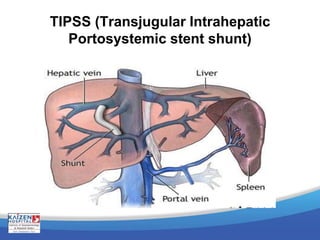 TIPSS (Transjugular Intrahepatic
Portosystemic stent shunt)
 