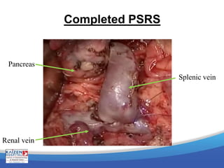 Completed PSRS
Pancreas
Renal vein
Splenic vein
 