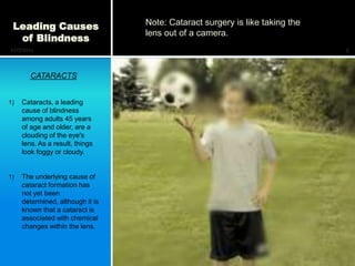 Leading Causes                   Note: Cataract surgery is like taking the
                                  lens out of a camera.
  of Blindness
12/7/2011                                                                     5



        CATARACTS


1)   Cataracts, a leading
     cause of blindness
     among adults 45 years
     of age and older, are a
     clouding of the eye's
     lens. As a result, things
     look foggy or cloudy.


1)   The underlying cause of
     cataract formation has
     not yet been
     determined, although it is
     known that a cataract is
     associated with chemical
     changes within the lens.
 