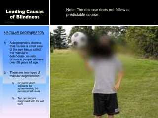 Leading Causes                      Note: The disease does not follow a
                                     predictable course.
  of Blindness
12/7/2011                                                                  7



MACULAR DEGENERATION


1)   A degenerative disease
     that causes a small area
     of the eye tissue called
     the macula to
     deteriorate, usually
     occurs in people who are
     over 50 years of age.


2)   There are two types of
     macular degeneration:

      1)    Dry form which
            accounts for
            approximately 90
            percent of all cases

      2)    Ten percent are
            diagnosed with the wet
            form
 