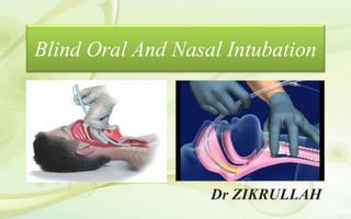 Blind Oral And Nasal Intubation
Dr ZIKRULLAH
 