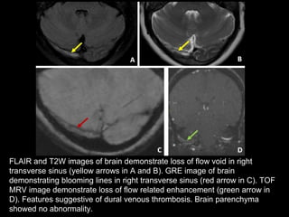 Void Brain Blind spot in brain imaging | PPTX