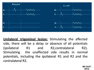 (ipsilateral R1 and R2,contralateral R2).
Stimulating the unaffected side results in normal
Unilateral trigeminal lesion: Stimulating the affected
side, there will be a delay or absence of all potentials
potentials, including the ipsilateral R1 and R2 and the
contralateral R2.
IM 18-07-
2012.
 