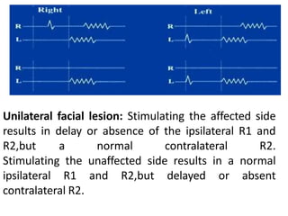 Unilateral facial lesion: Stimulating the affected side
results in delay or absence of the ipsilateral R1 and
R2,but a normal contralateral R2.
Stimulating the unaffected side results in a normal
ipsilateral R1 and R2,but delayed or absent
contralateral R2.
 