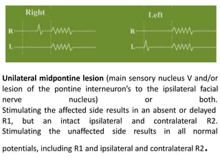 Unilateral midpontine lesion (main sensory nucleus V and/or
lesion of the pontine interneuron’s to the ipsilateral facial
nerve nucleus) or both.
Stimulating the affected side results in an absent or delayed
Stimulating
R1, but an intact ipsilateral and contralateral R2.
the unaffected side results in all normal
potentials, including R1 and ipsilateral and contralateral R2.
 