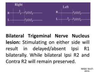 Bilateral Trigeminal Nerve Nucleus
lesion: Stimulating on either side will
result in delayed/absent Ipsi R1
bilaterally. While bilateral Ipsi R2 and
Contra R2 will remain preserved.
IM/EK 18-07-
2012.
 