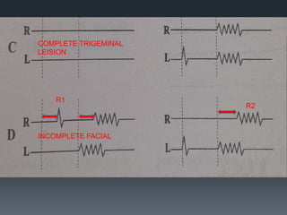 COMPLETE TRIGEMINAL
LEISION
R1
INCOMPLETE FACIAL
R2
 