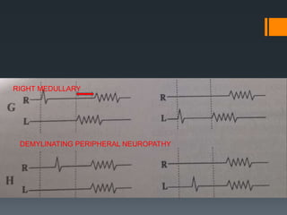 RIGHT MEDULLARY
DEMYLINATING PERIPHERAL NEUROPATHY
 