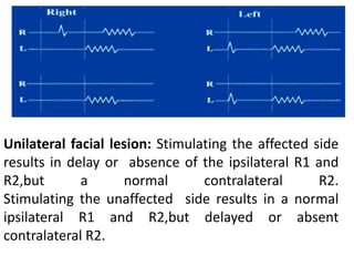 Unilateral facial lesion: Stimulating the affected side
results in delay or absence of the ipsilateral R1 and
R2,but       a      normal       contralateral      R2.
Stimulating the unaffected side results in a normal
ipsilateral R1 and R2,but delayed or absent
contralateral R2.
 