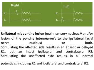 Unilateral midpontine lesion (main sensory nucleus V and/or
lesion of the pontine interneuron’s to the ipsilateral facial
nerve              nucleus)               or            both.
Stimulating the affected side results in an absent or delayed
R1, but an intact ipsilateral and contralateral R2.
Stimulating the unaffected side results in all normal

                                                            .
potentials, including R1 and ipsilateral and contralateral R2
 